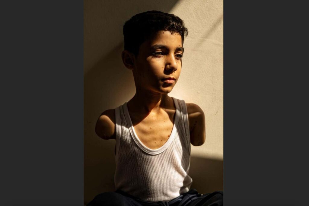 Una imagen sobre las secuelas de la guerra en niños gazatíes gana el World Press Photo